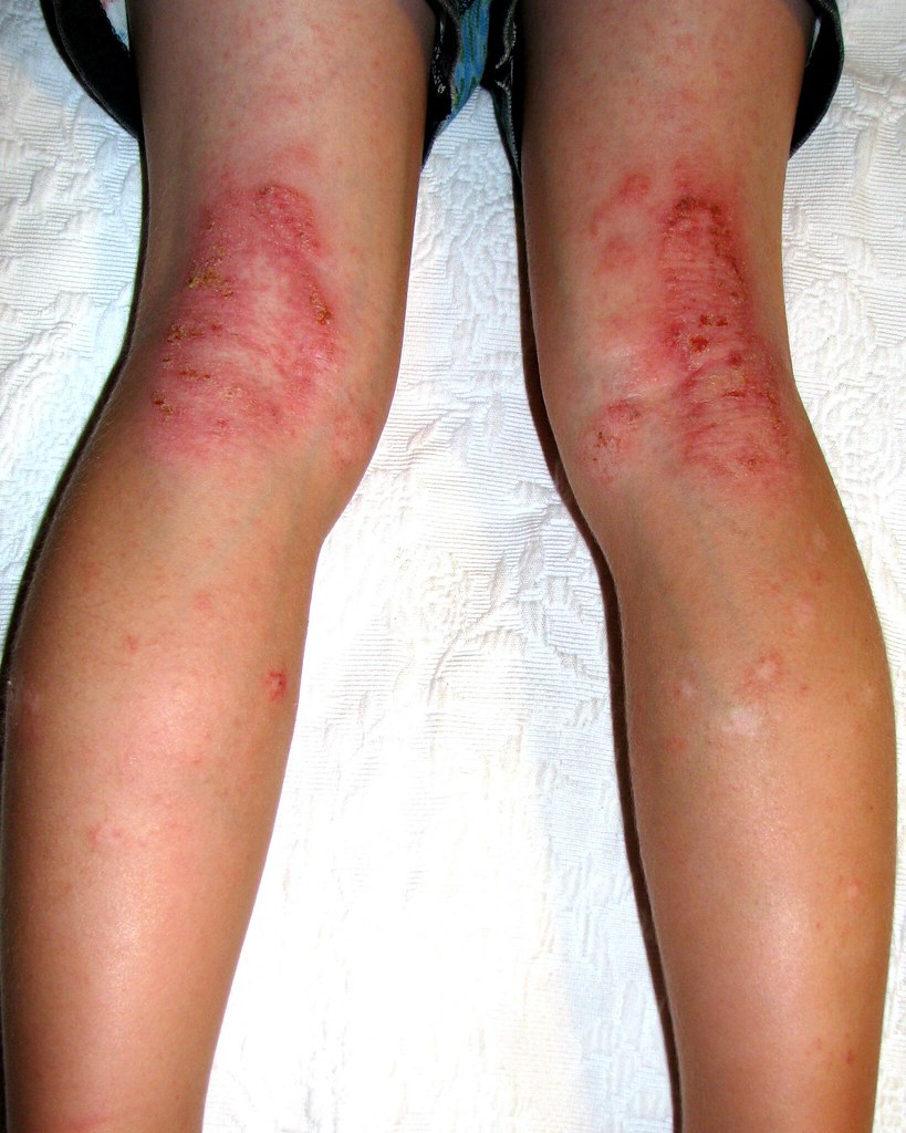 Eczema Behind Knee